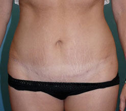 Abdominoplasty Before & After Image