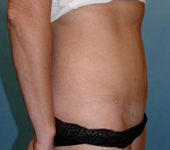 Abdominoplasty Before & After Image