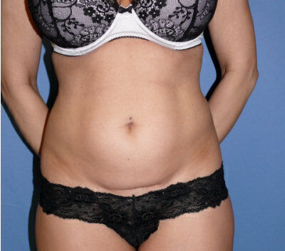 Abdominoplasty Before & After Image