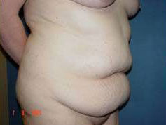 Abdominoplasty Before & After Image