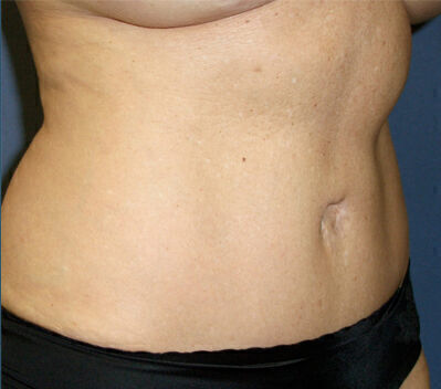 Abdominoplasty Before & After Image