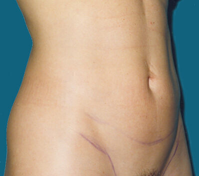 Abdominoplasty Before & After Image