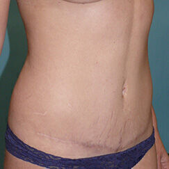 Abdominoplasty Before & After Image