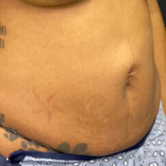 Abdominoplasty Before & After Image