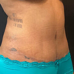 Abdominoplasty Before & After Image