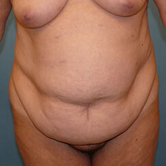 Abdominoplasty Before & After Image