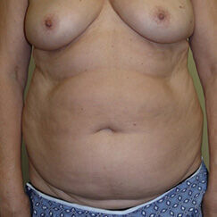 Abdominoplasty Before & After Image