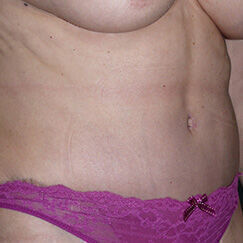 Abdominoplasty Before & After Image