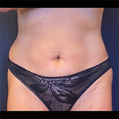 Abdominoplasty Before & After Image