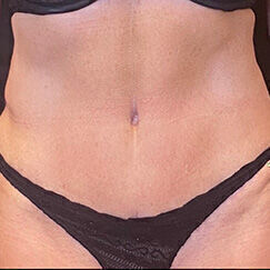 Abdominoplasty Before & After Image