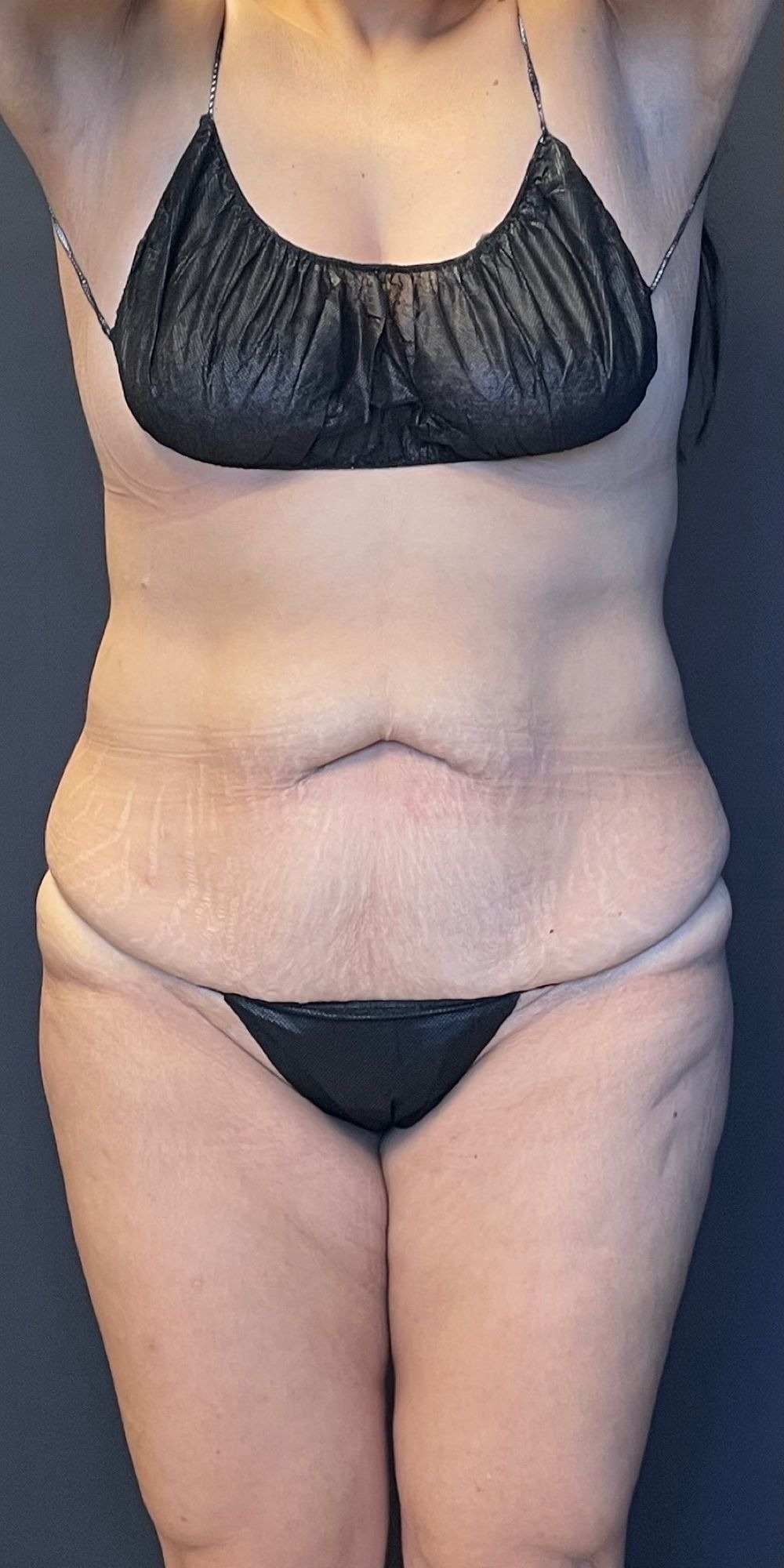 Abdominoplasty Before & After Image