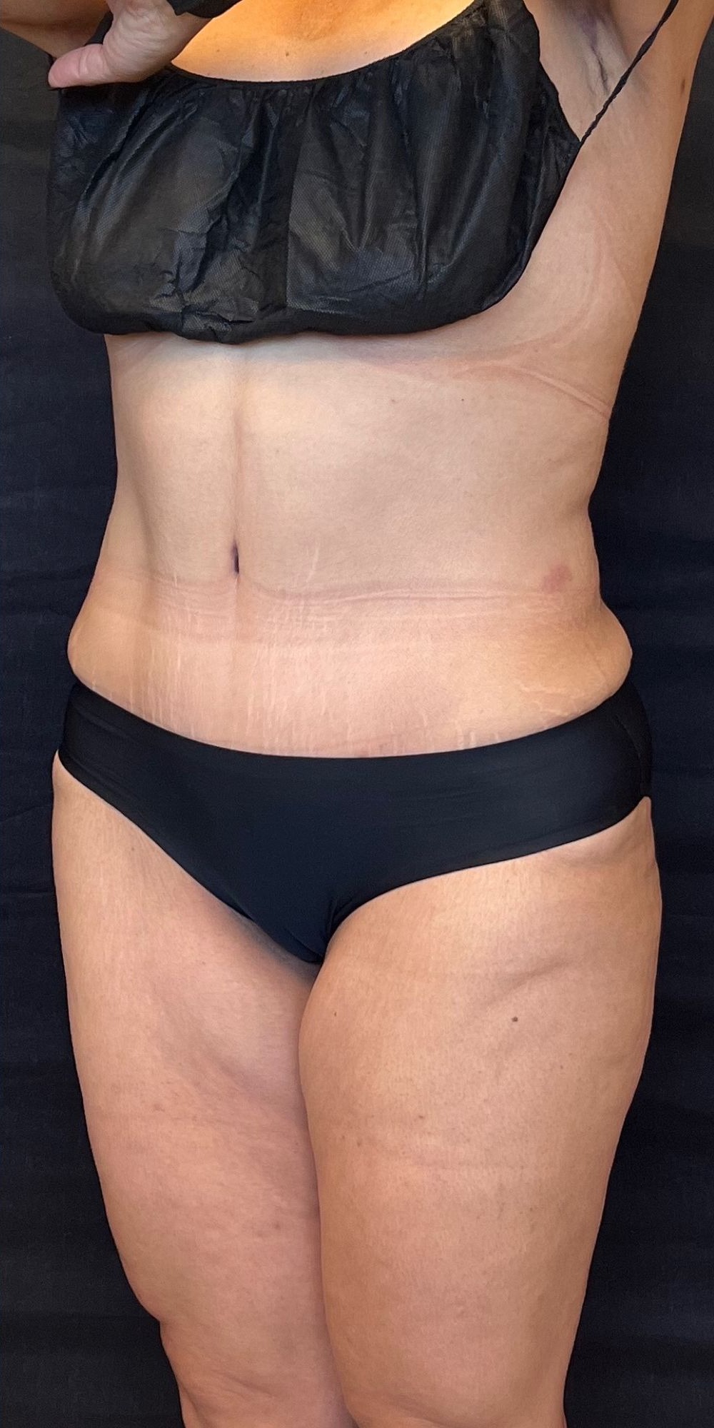 Abdominoplasty Before & After Image