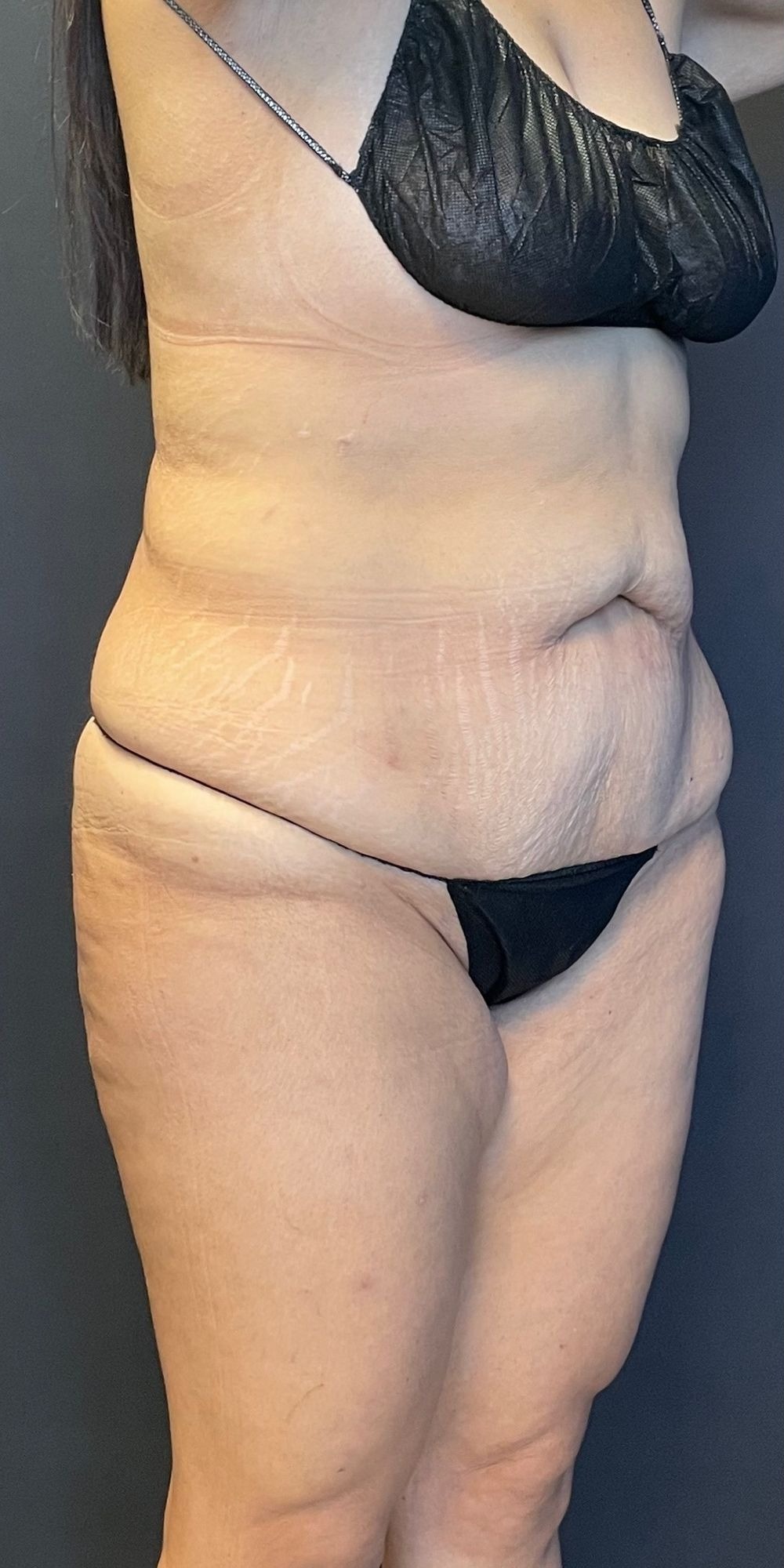 Abdominoplasty Before & After Image