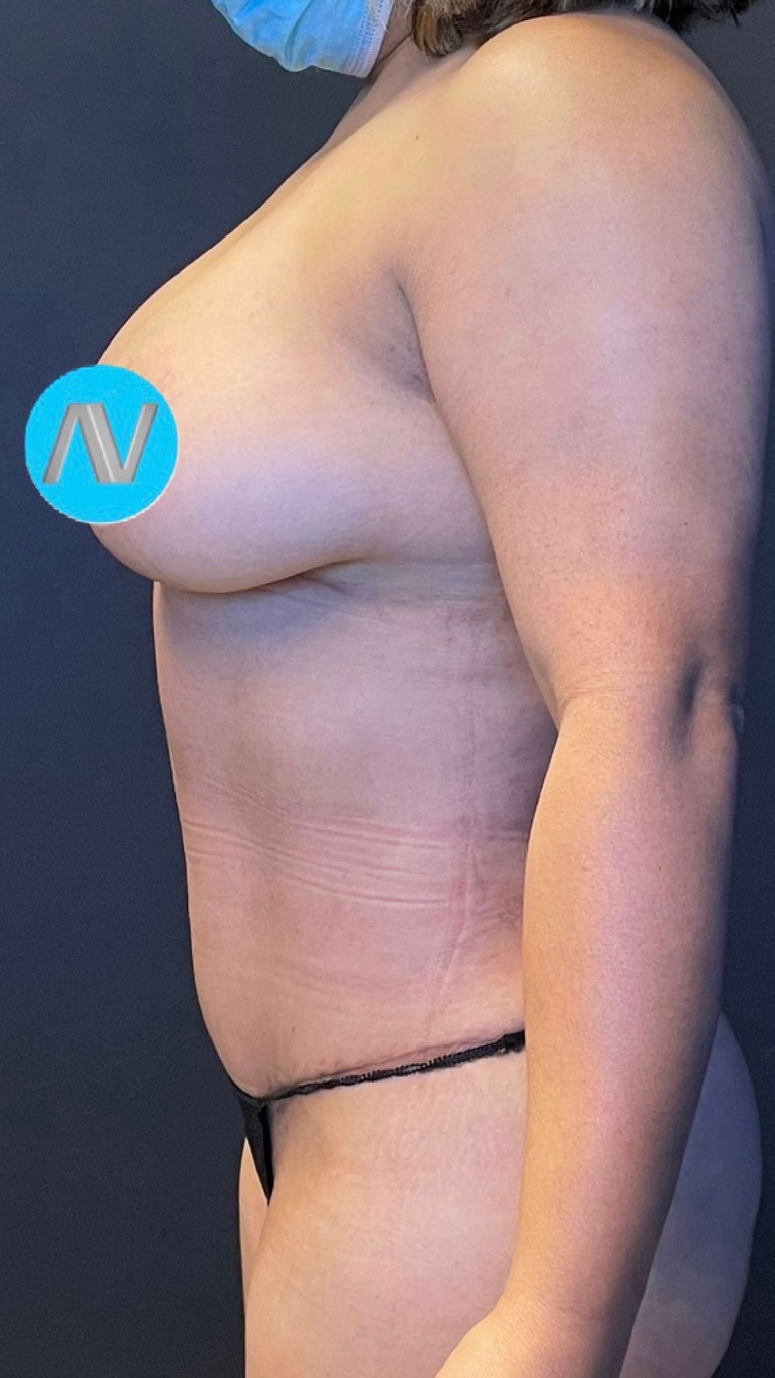 Abdominoplasty Before & After Image