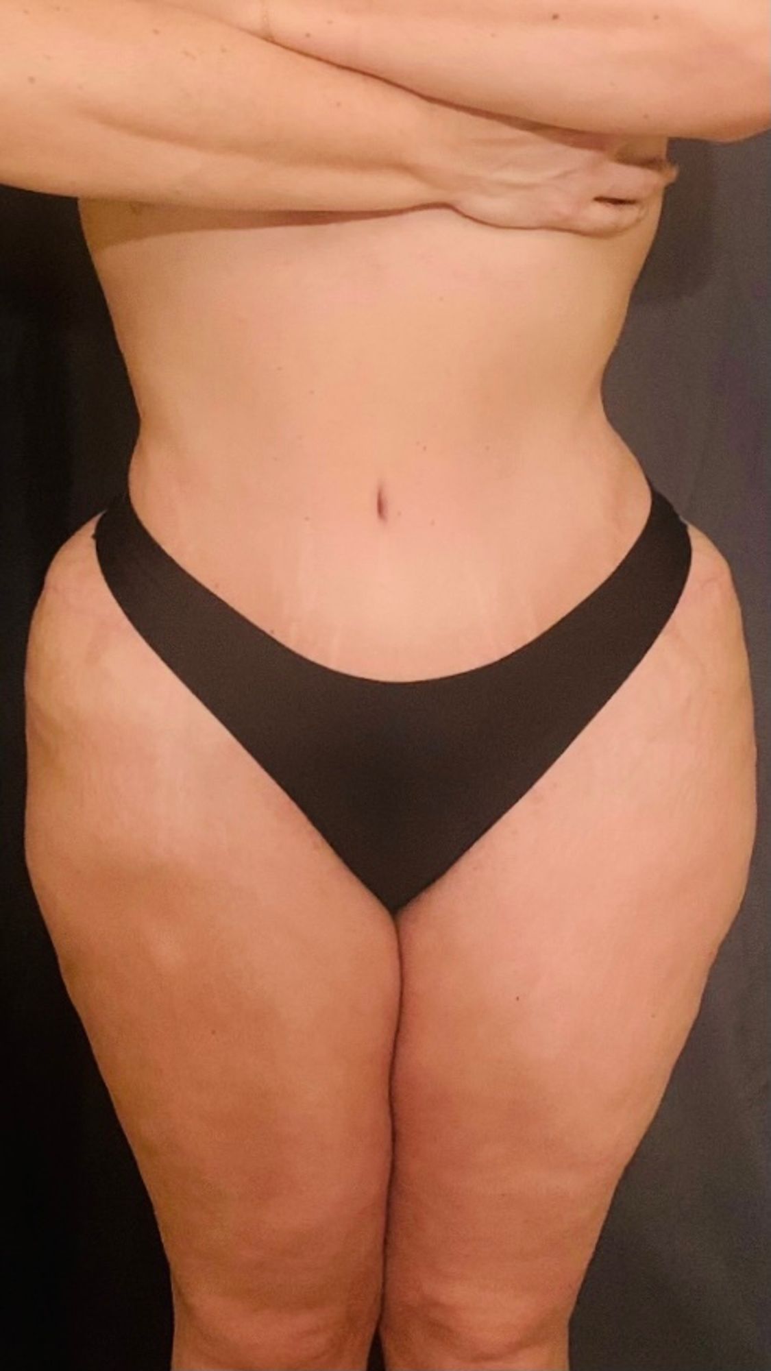 Abdominoplasty Before & After Image