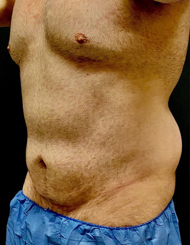 Atlas Before & After Image