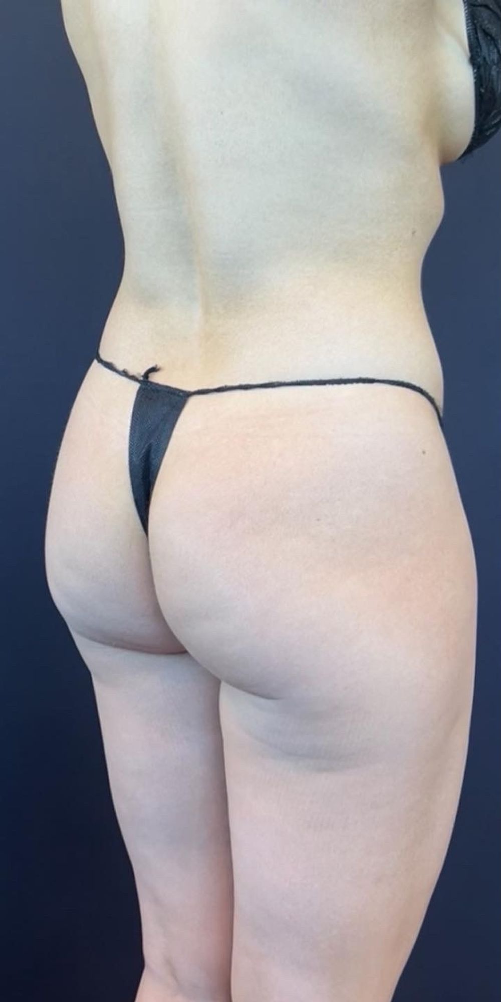 Brazilian Butt Lift Before & After Image