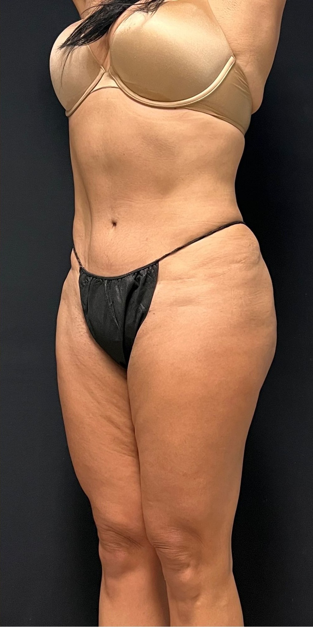 Brazilian Butt Lift Before & After Image