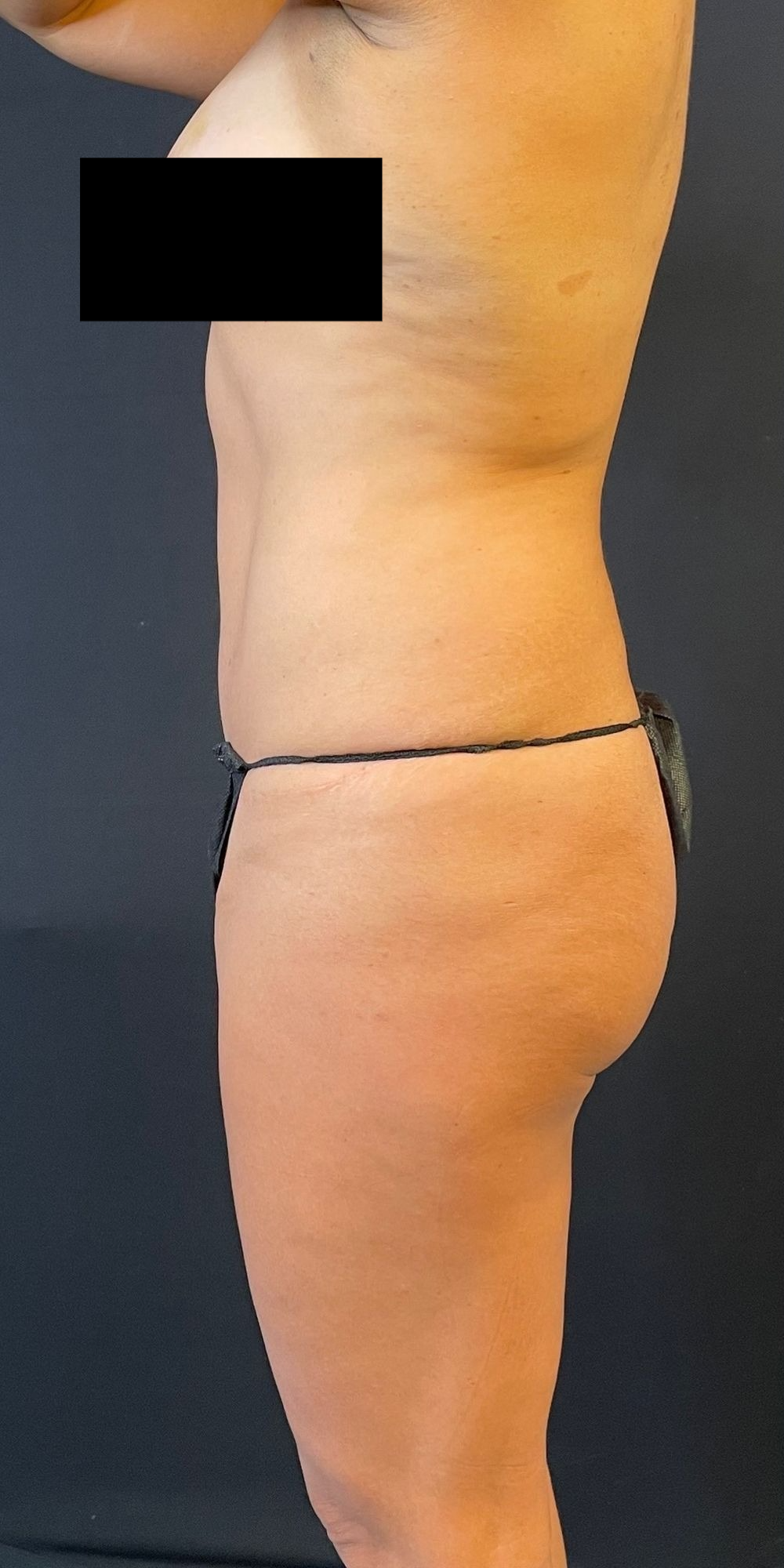 Brazilian Butt Lift Before & After Image