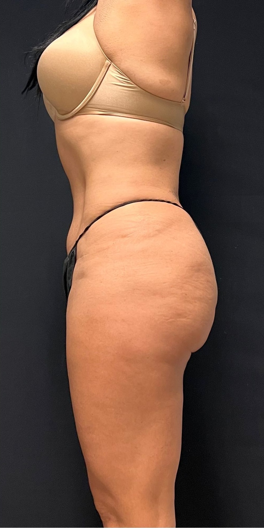 Brazilian Butt Lift Before & After Image