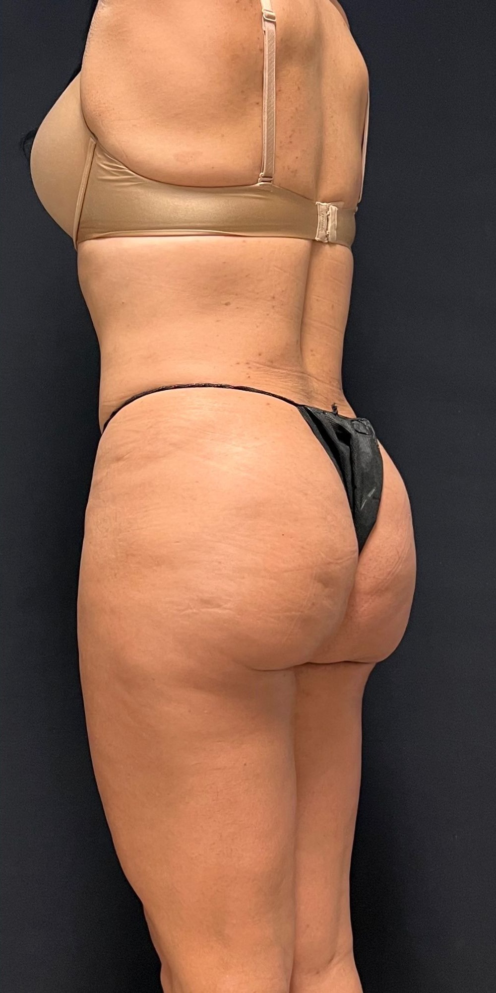 Brazilian Butt Lift Before & After Image