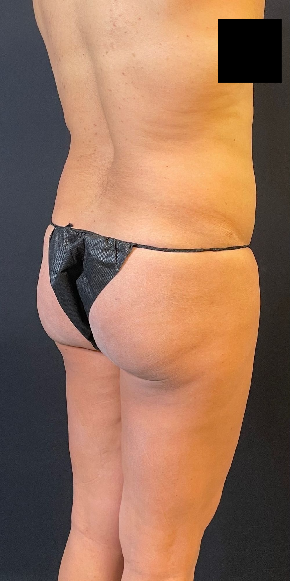 Brazilian Butt Lift Before & After Image