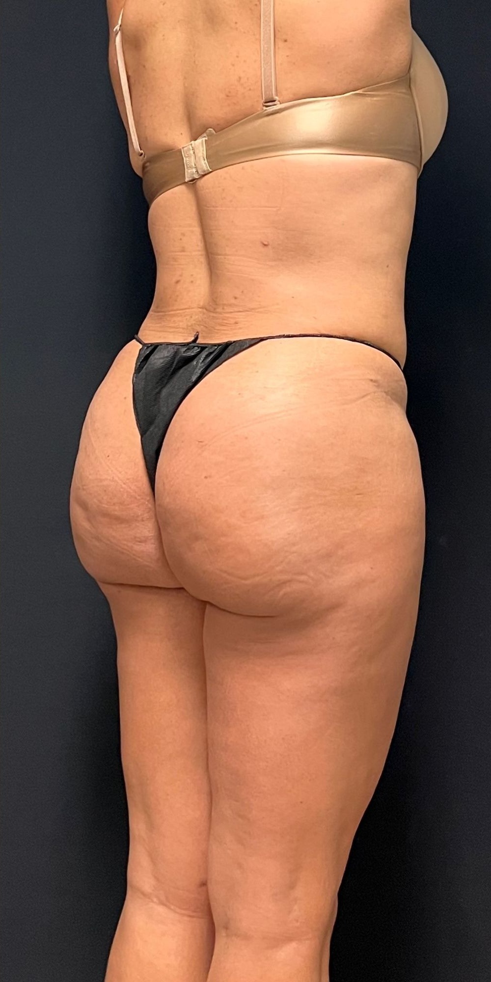 Brazilian Butt Lift Before & After Image