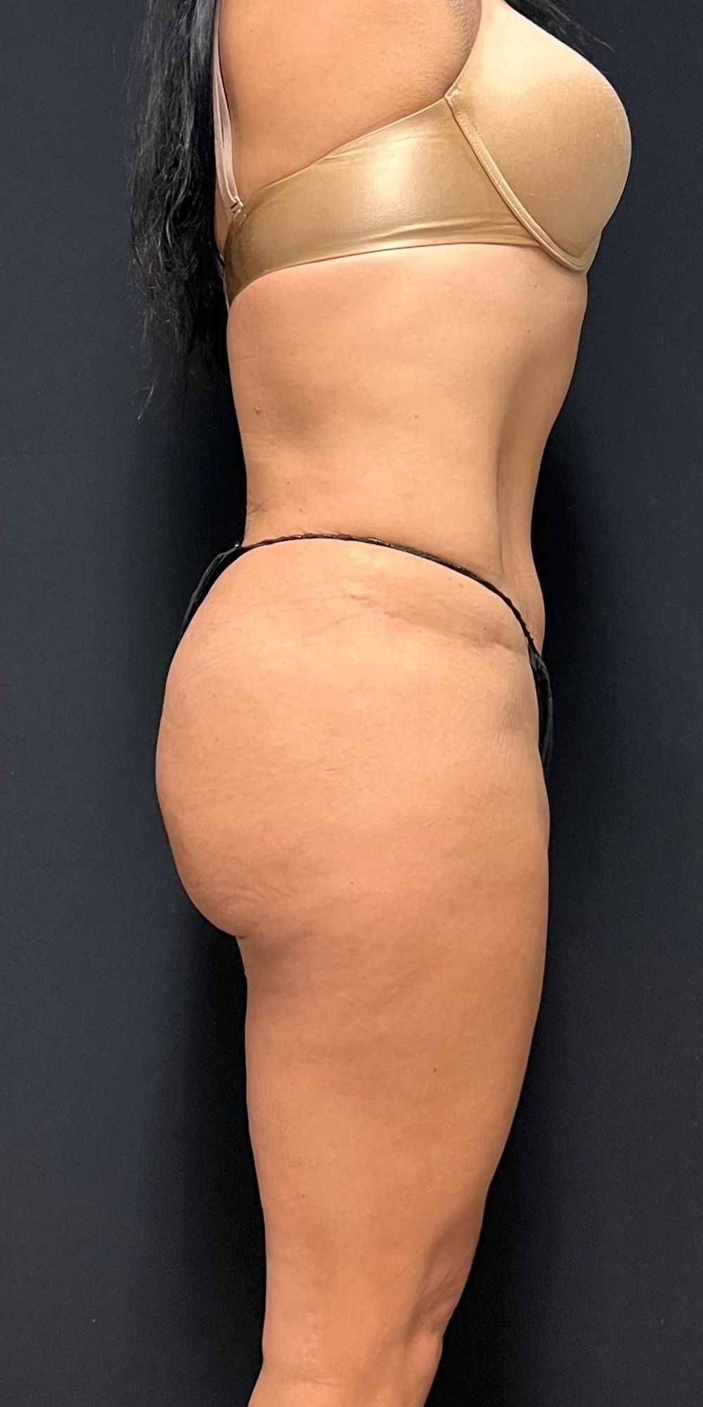 Brazilian Butt Lift Before & After Image