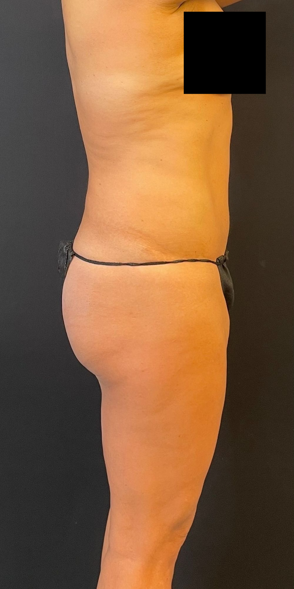 Brazilian Butt Lift Before & After Image