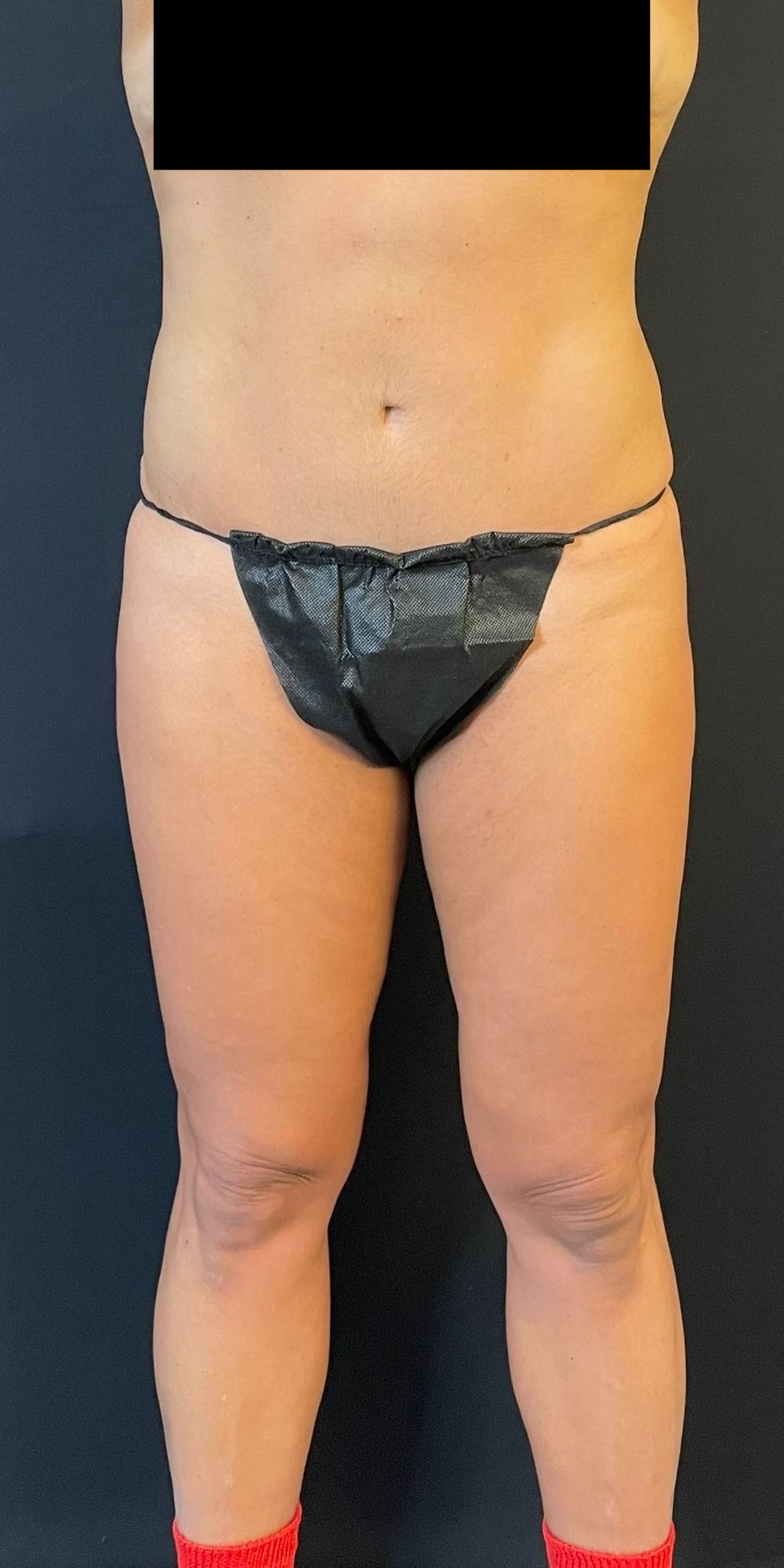 Brazilian Butt Lift Before & After Image