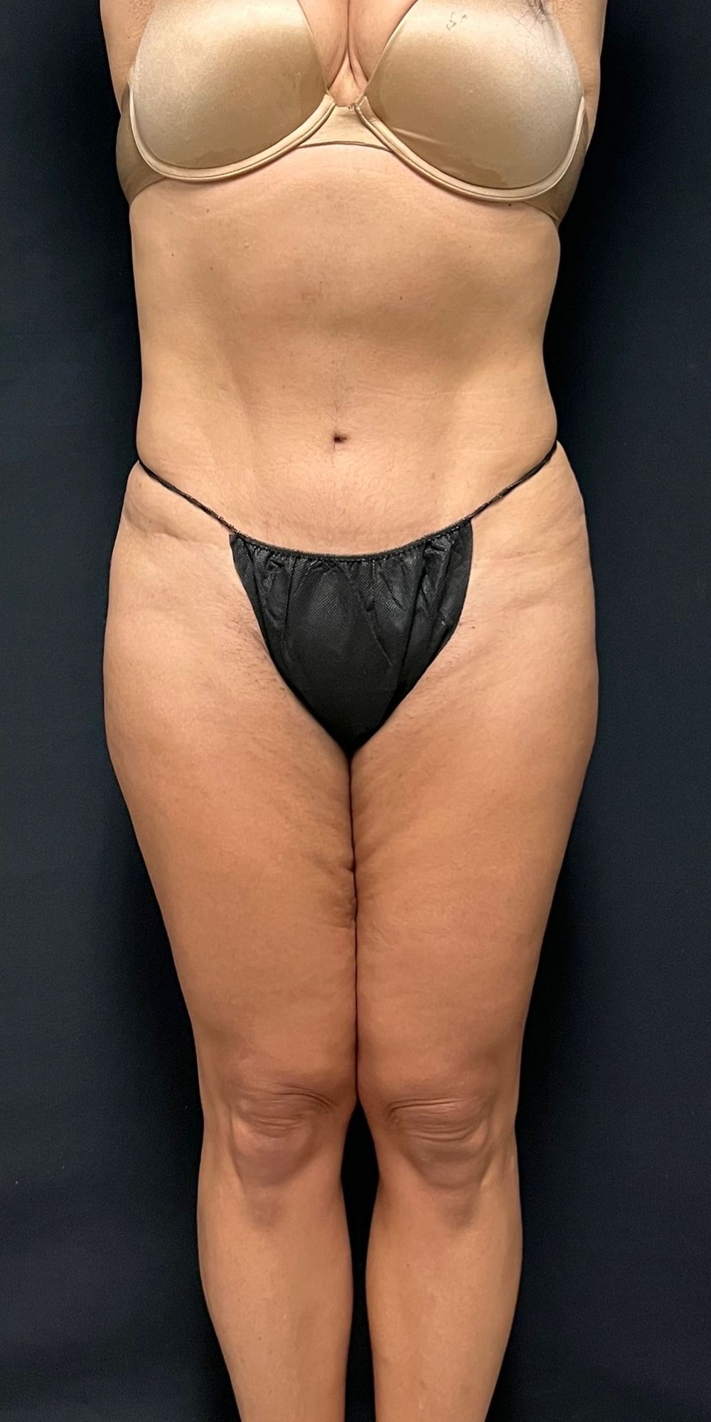 Brazilian Butt Lift Before & After Image