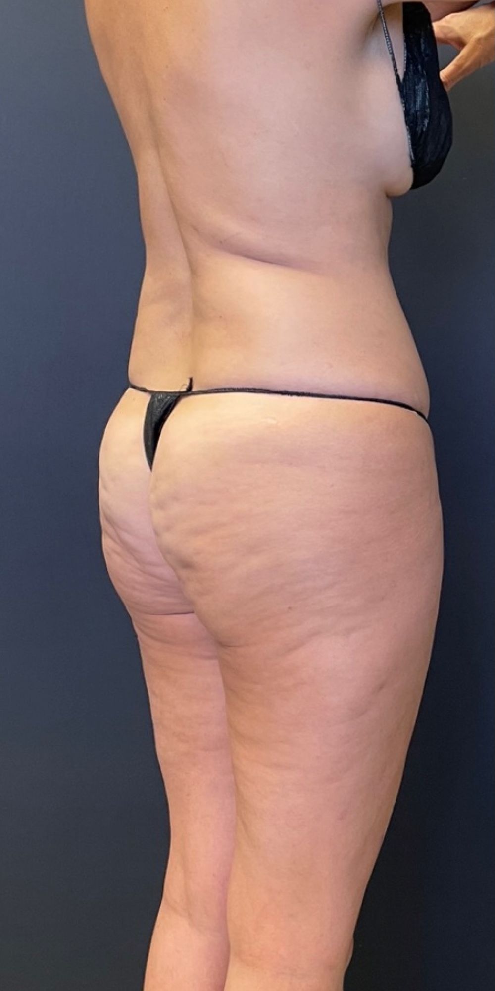 Brazilian Butt Lift Before & After Image