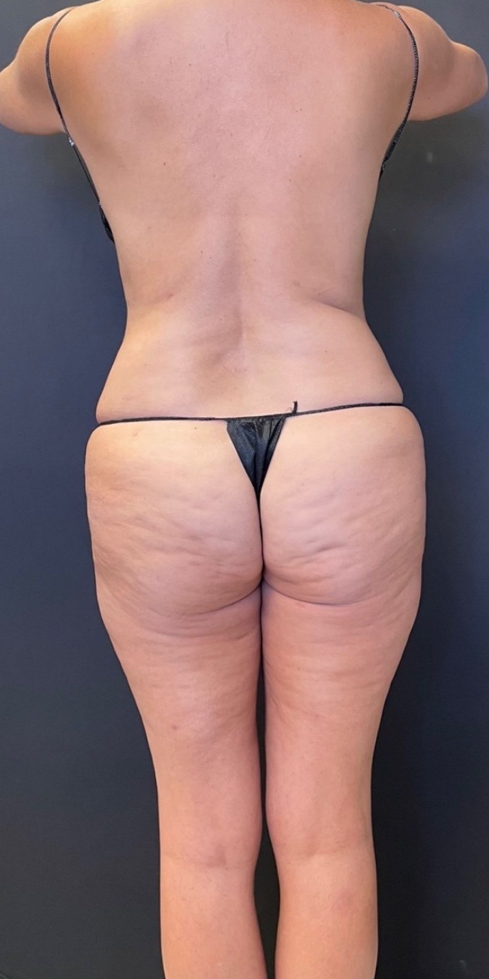 Brazilian Butt Lift Before & After Image