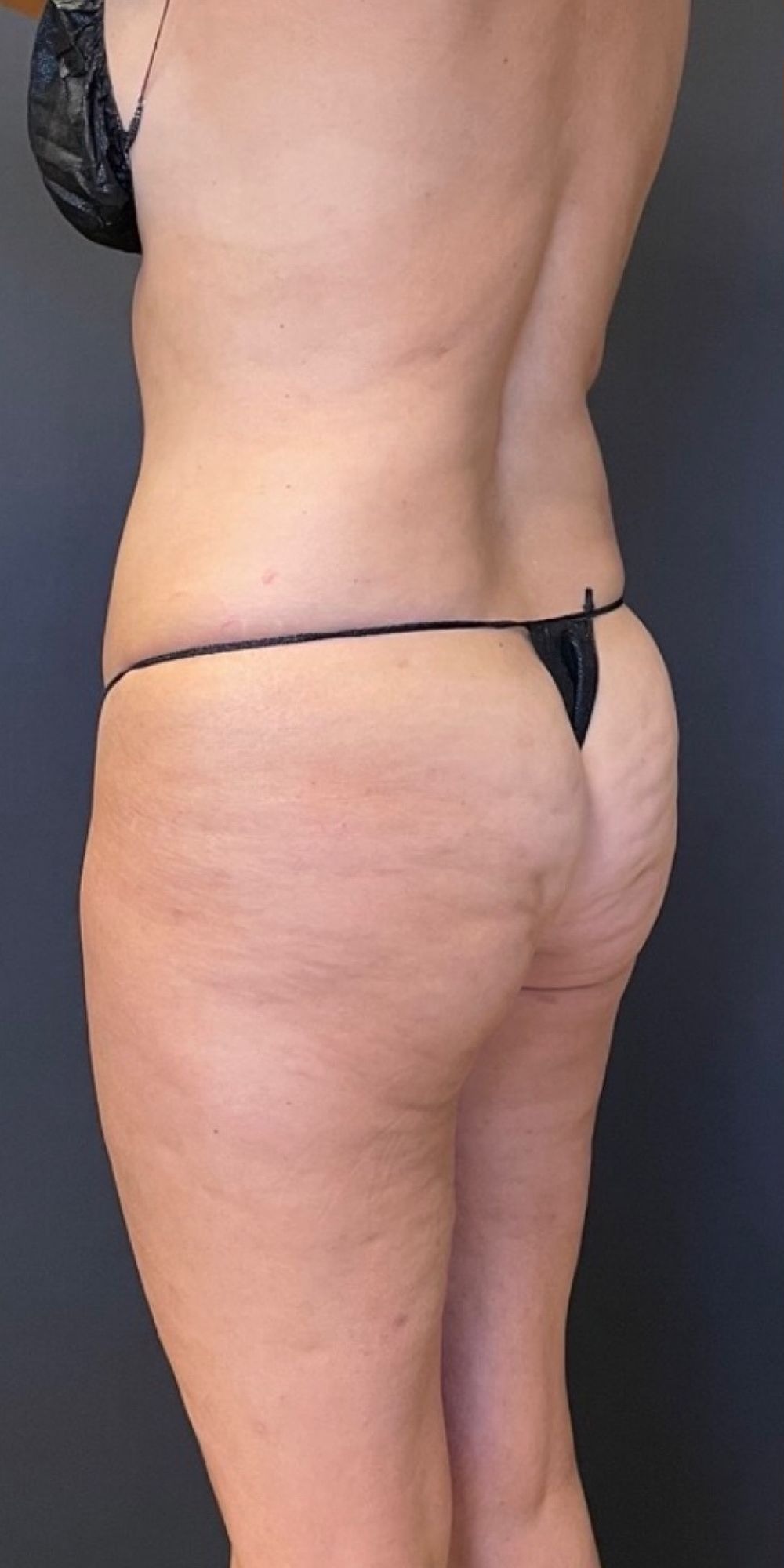 Brazilian Butt Lift Before & After Image