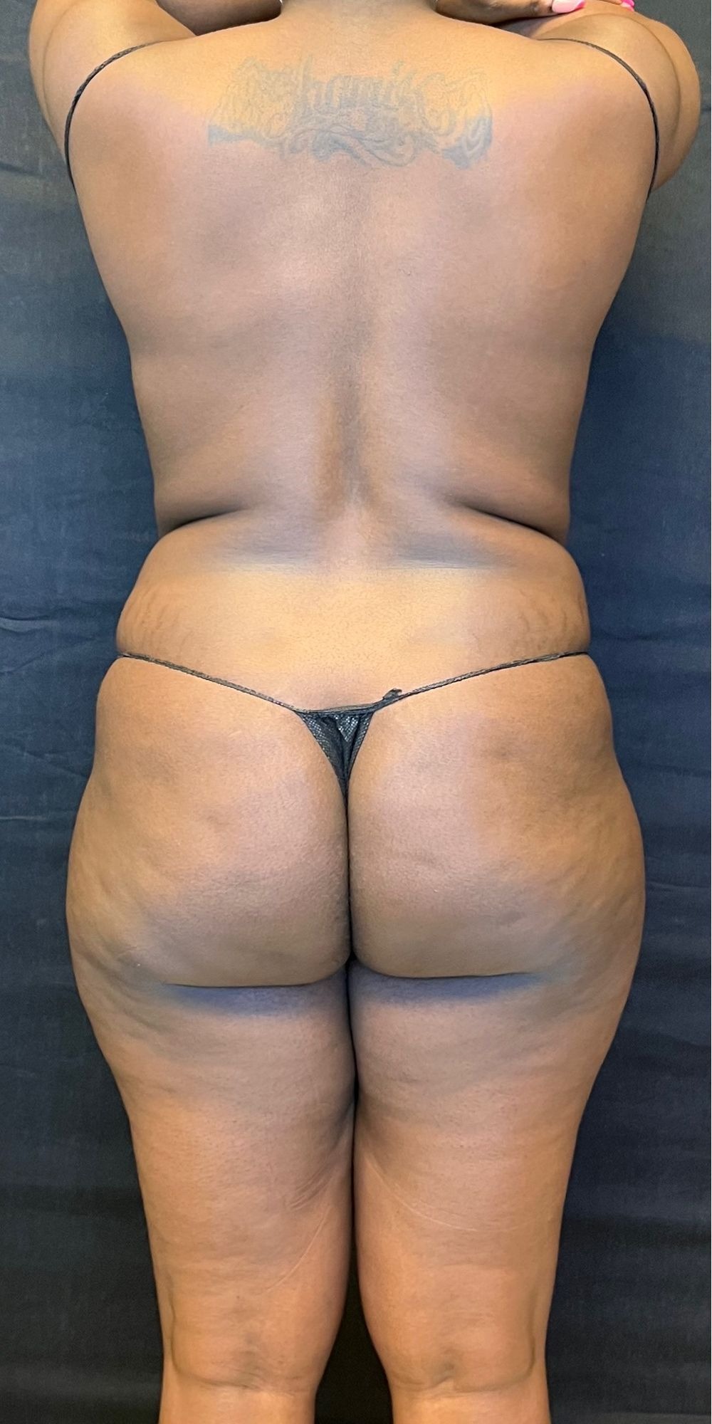 Brazilian Butt Lift Before & After Image