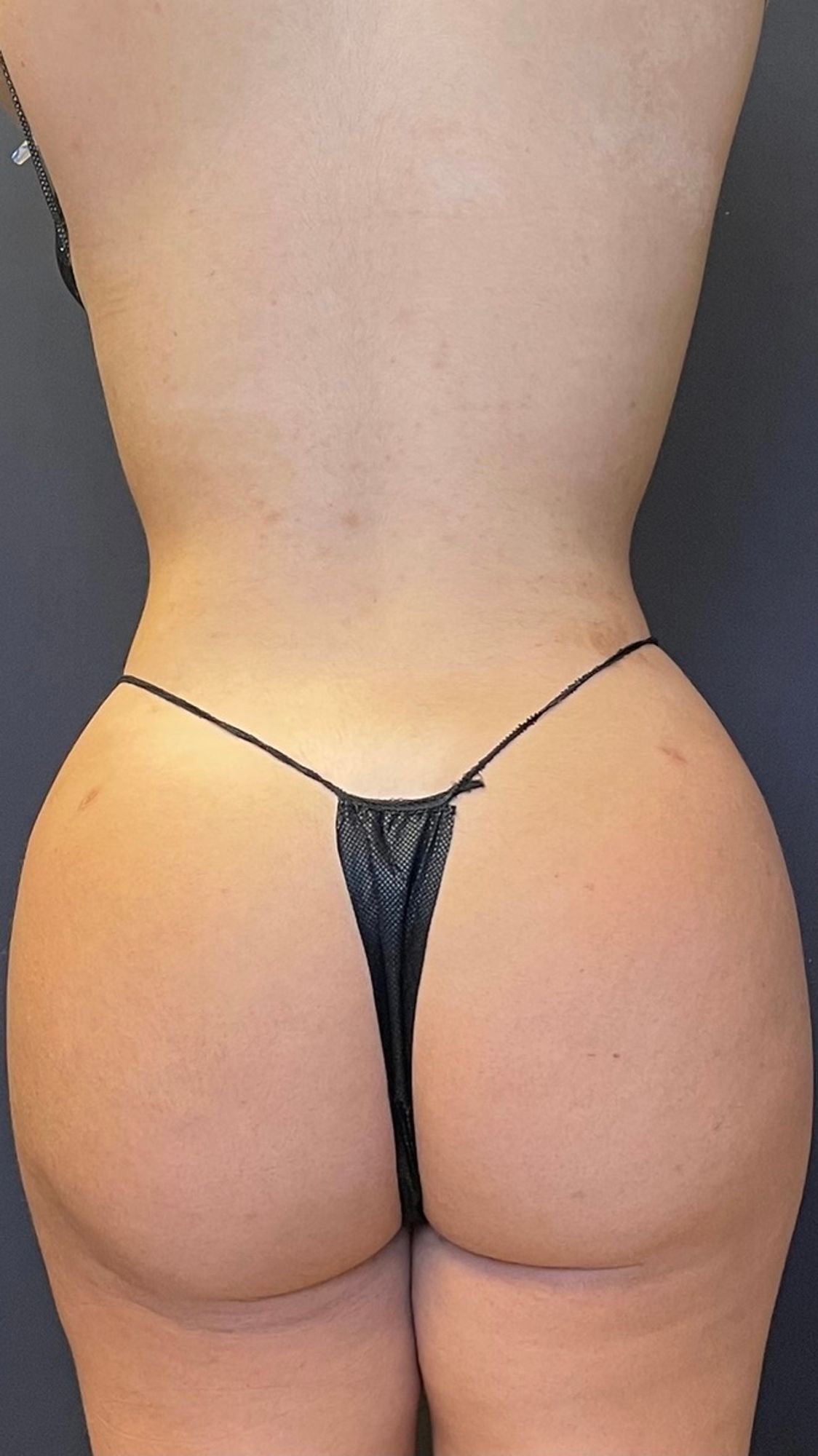 Brazilian Butt Lift Before & After Image