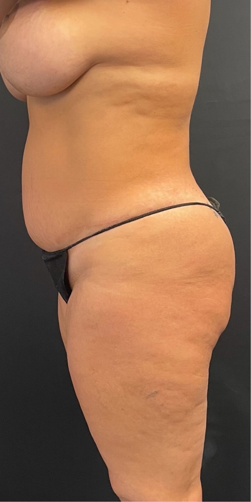 Brazilian Butt Lift Before & After Image