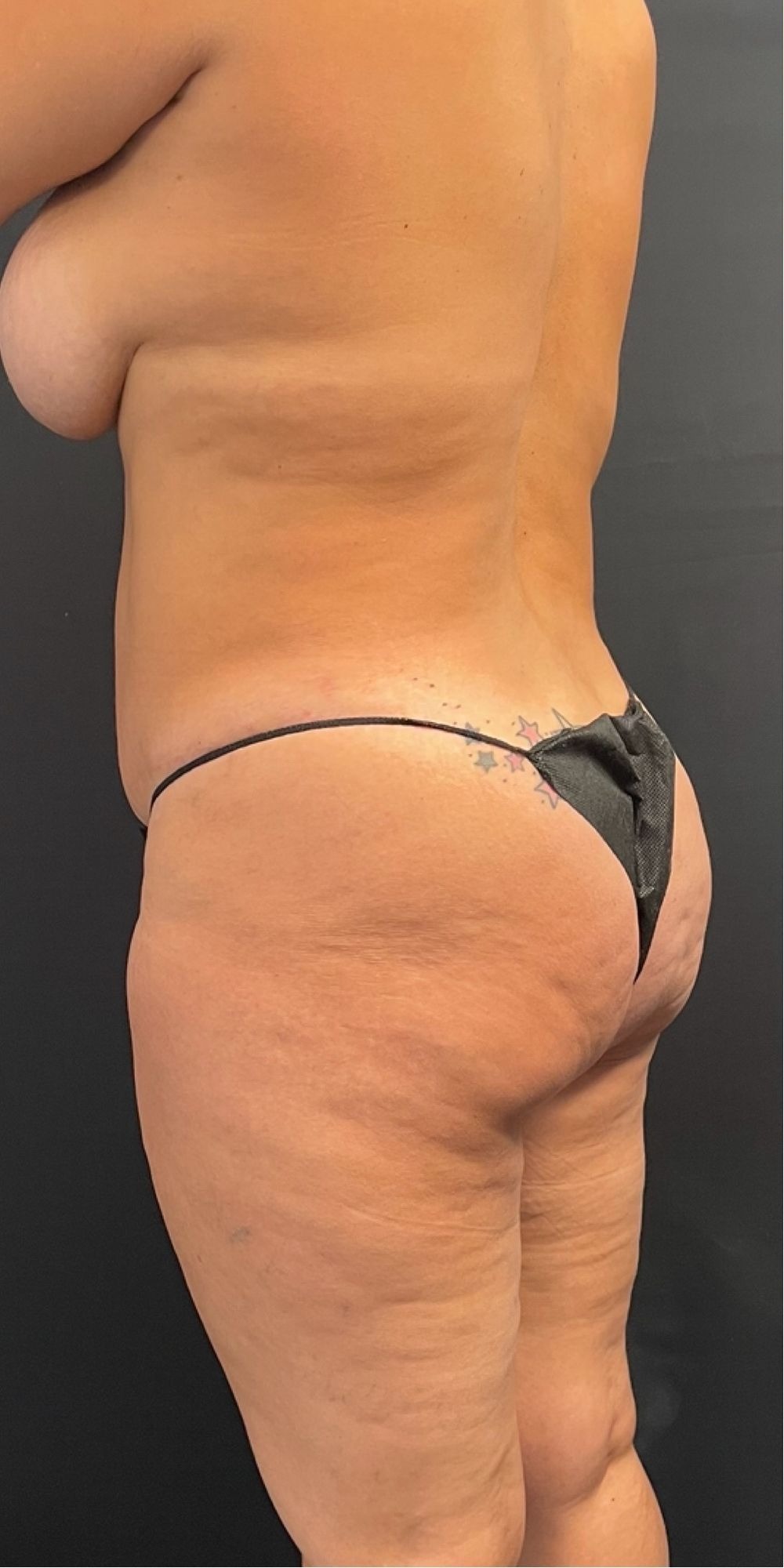 Brazilian Butt Lift Before & After Image