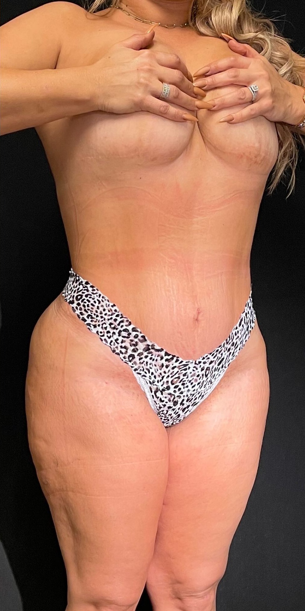 Brazilian Butt Lift Before & After Image