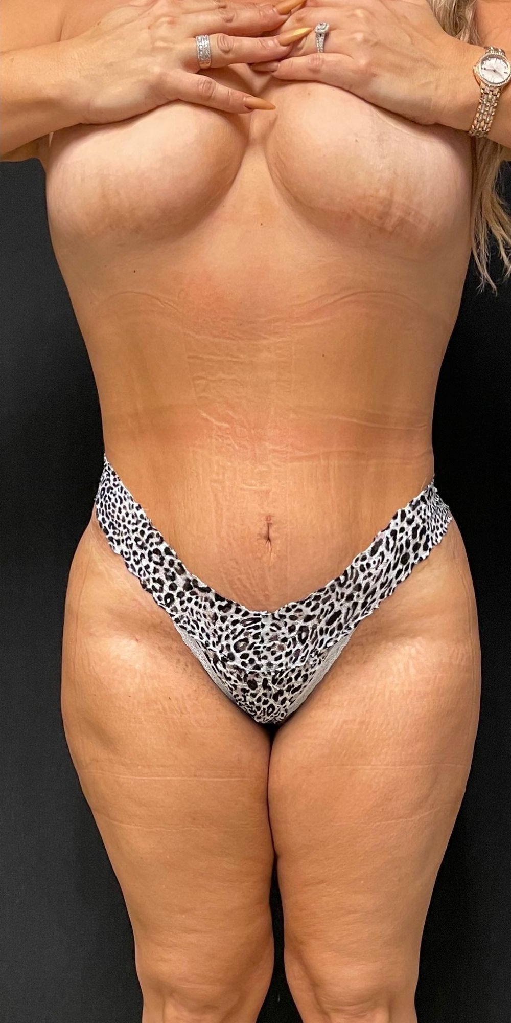 Brazilian Butt Lift Before & After Image