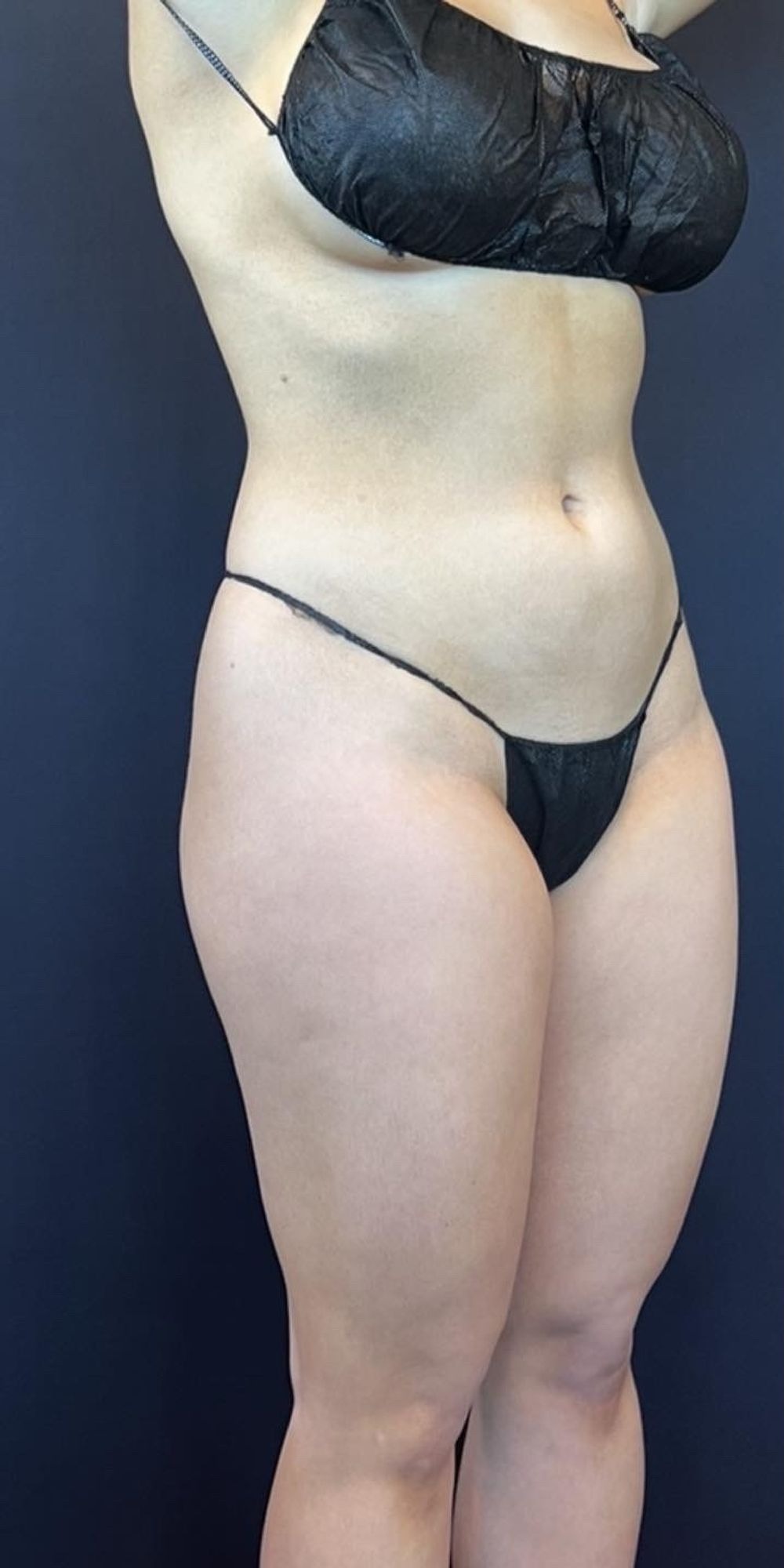 Brazilian Butt Lift Before & After Image