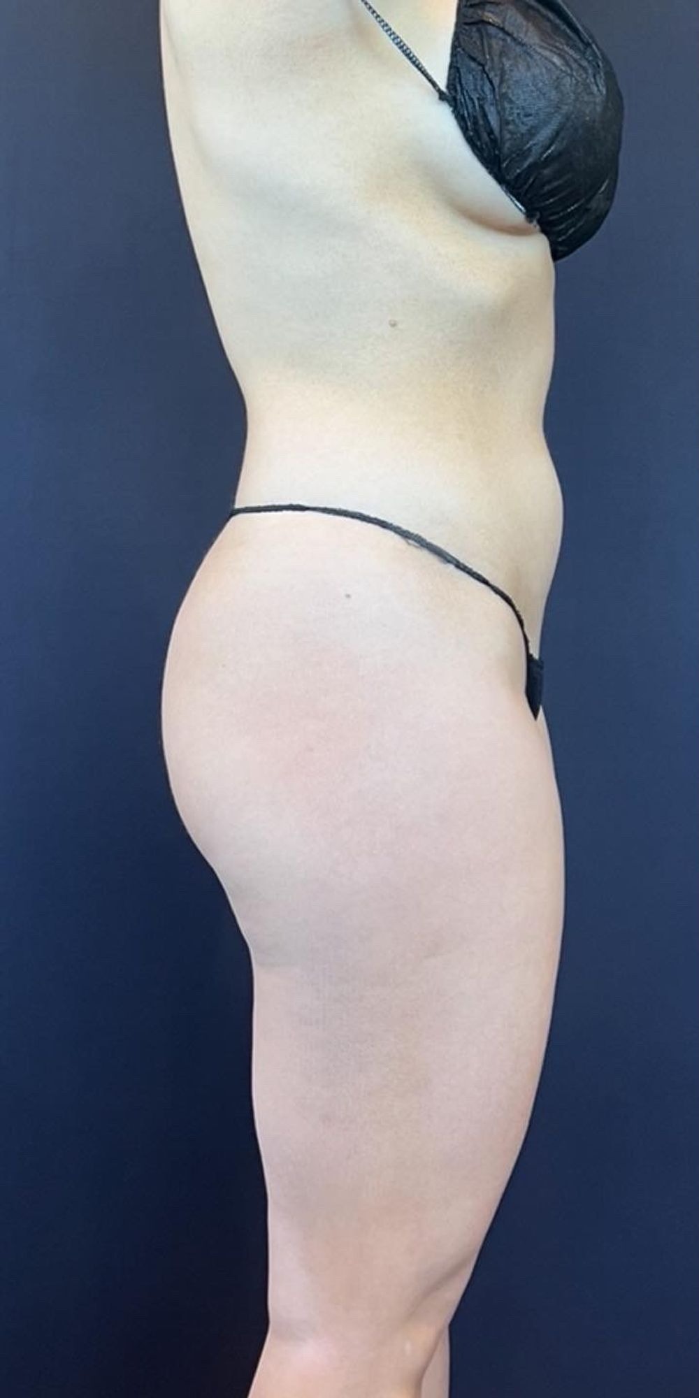 Brazilian Butt Lift Before & After Image