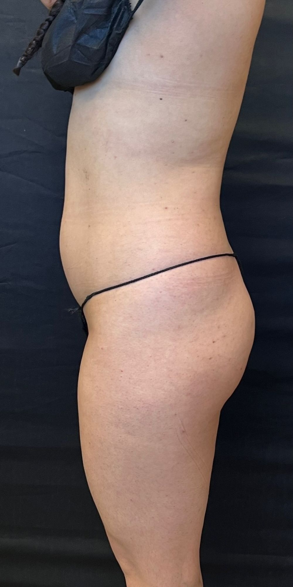 Brazilian Butt Lift Before & After Image