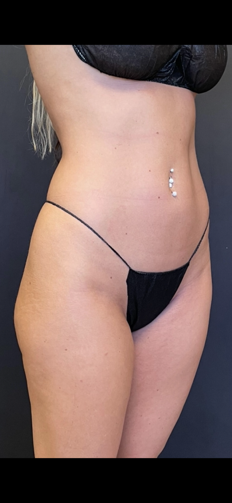 Brazilian Butt Lift Before & After Image