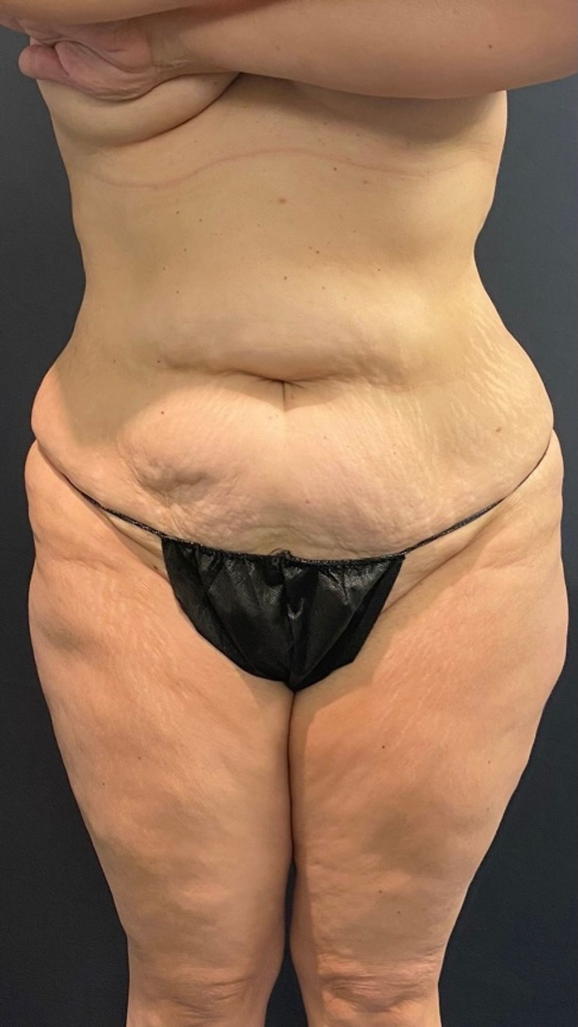 Brazilian Butt Lift Before & After Image