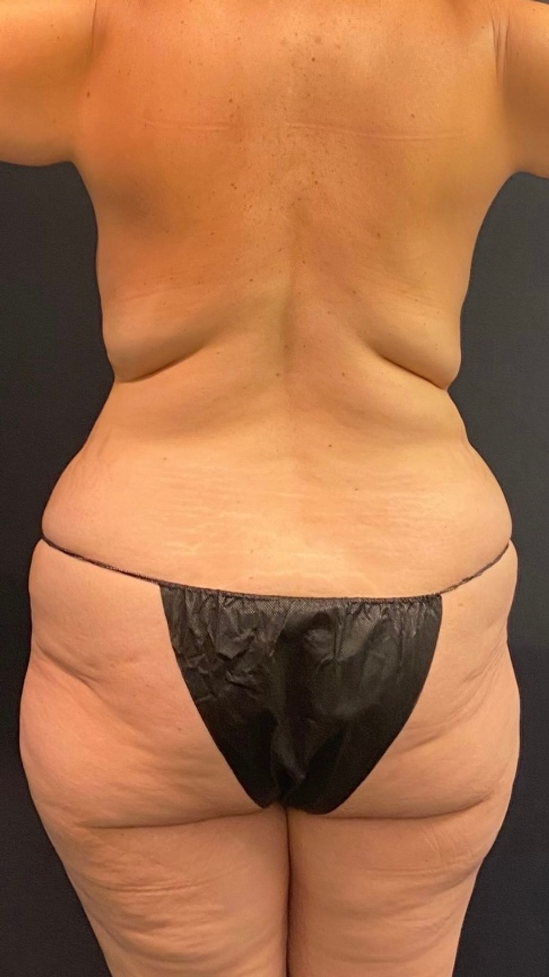 Brazilian Butt Lift Before & After Image