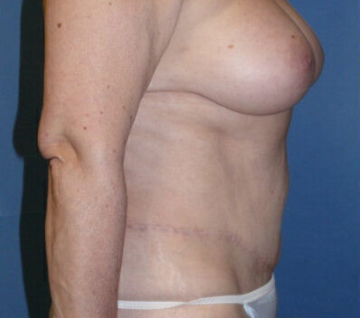 Body Contouring Before & After Image