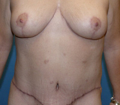 Body Contouring Before & After Image