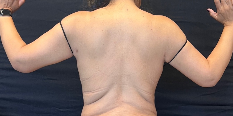 Brachioplasty Before & After Image