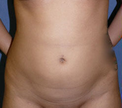 Liposuction Before & After Image